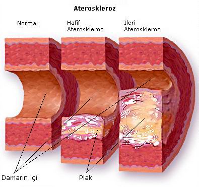 Aterosklerozun Gelişimi